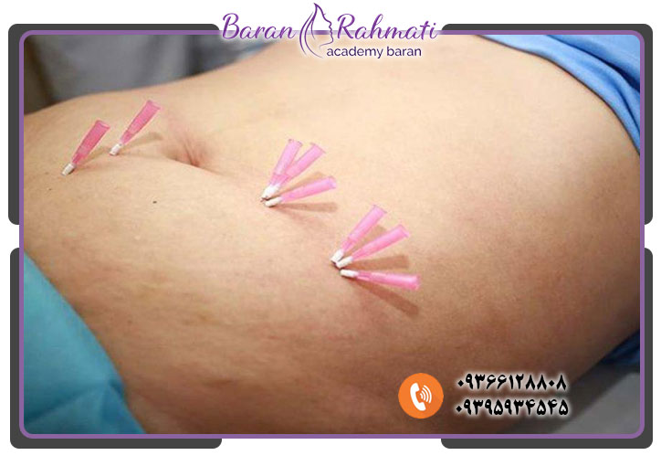 مزایای کاشت نخ امبدینگ