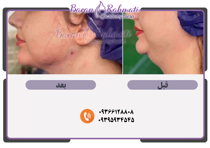 کارگاه آموزش رفع غبغب در تبریز