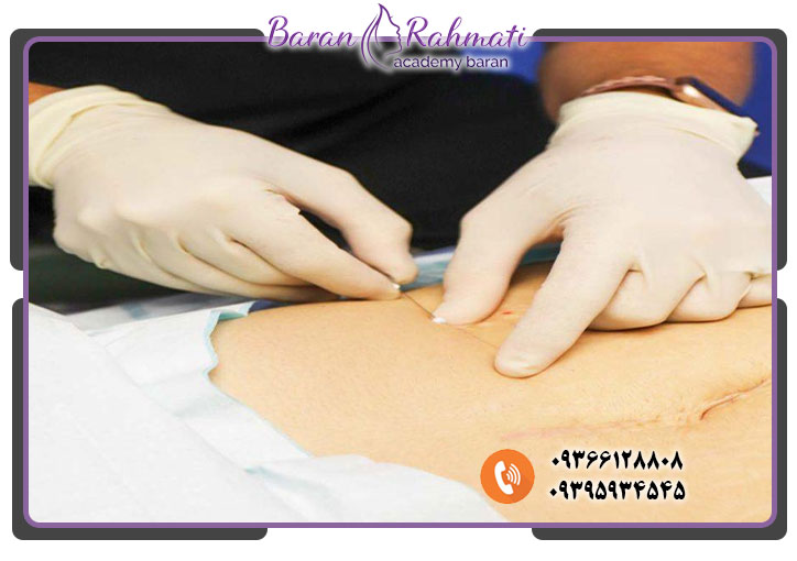 سرفصل دوره کاشت نخ امبدینگ