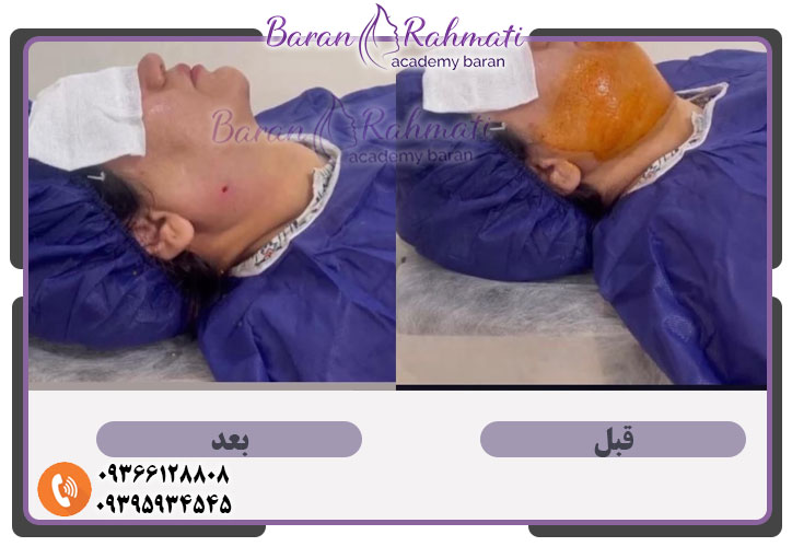 کیس مناسب رفع غبغب در تبریز