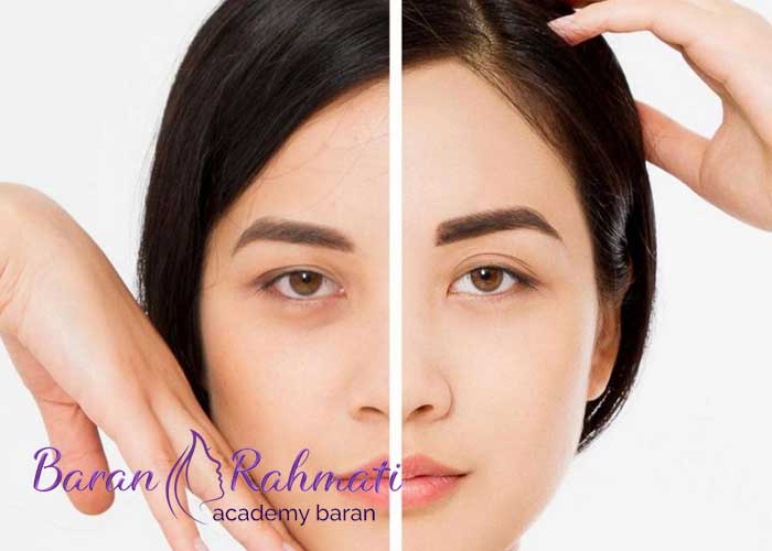 Read more about the article آموزش لیفت شقیقه در تهران