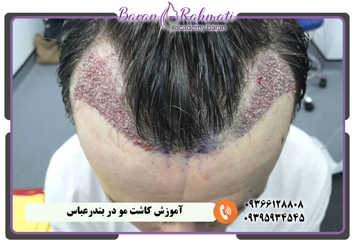 آموزش کاشت مو در بندرعباس با مدرک معتبر