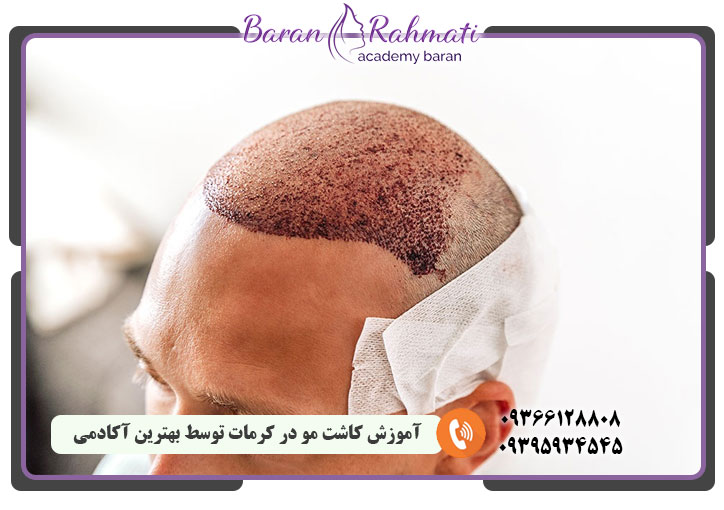 آموزش کاشت مو در کرمات توسط بهترین آکادمی