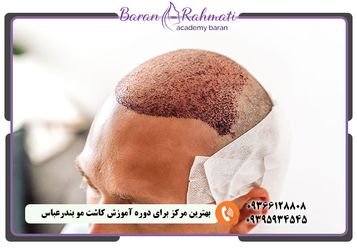 بهترین مرکز کاشت مو در بندر عباس