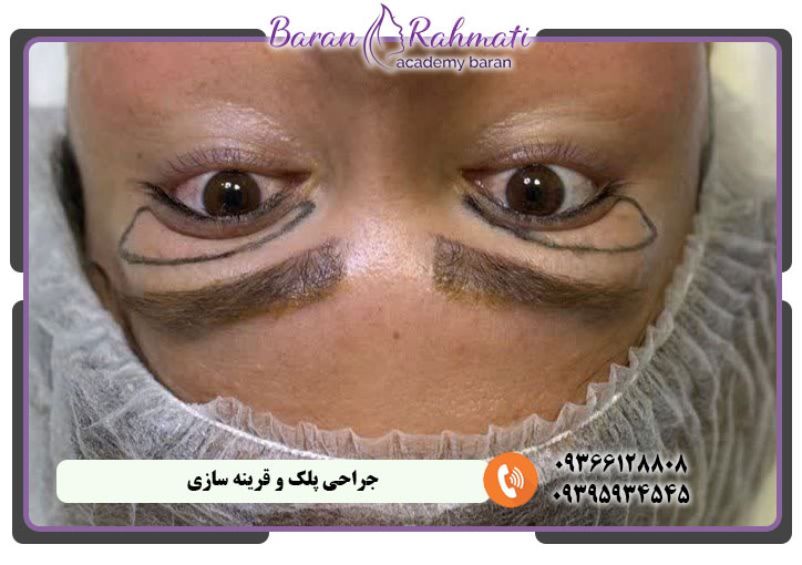 جراحی زیبایی پلک و قرینه سازی