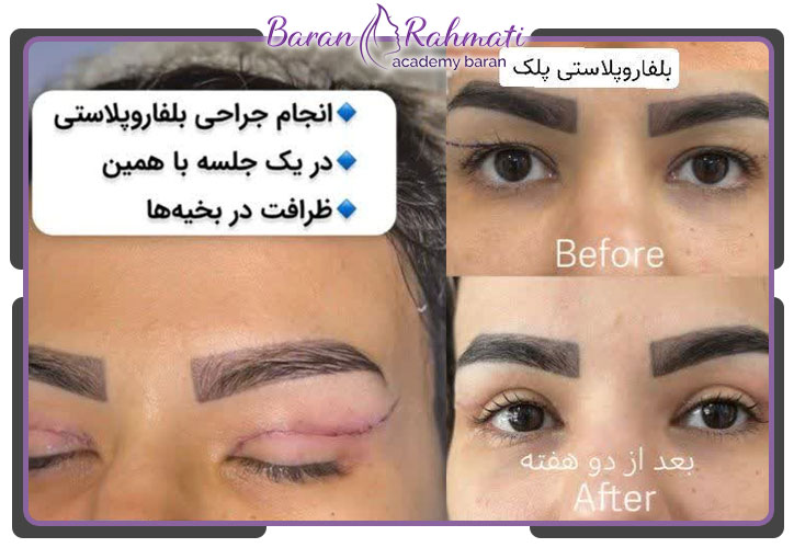 جراحی زیبایی پلک