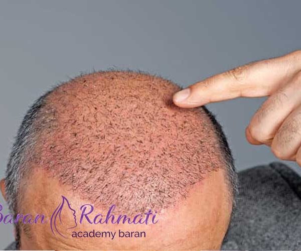 دوره آموزش کاشت مو در کرمان