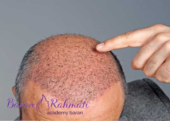 You are currently viewing آموزش کاشت مو در کرمان