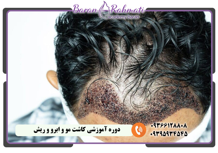 دوره آموزشی کاشت مو و ابرو و ریش