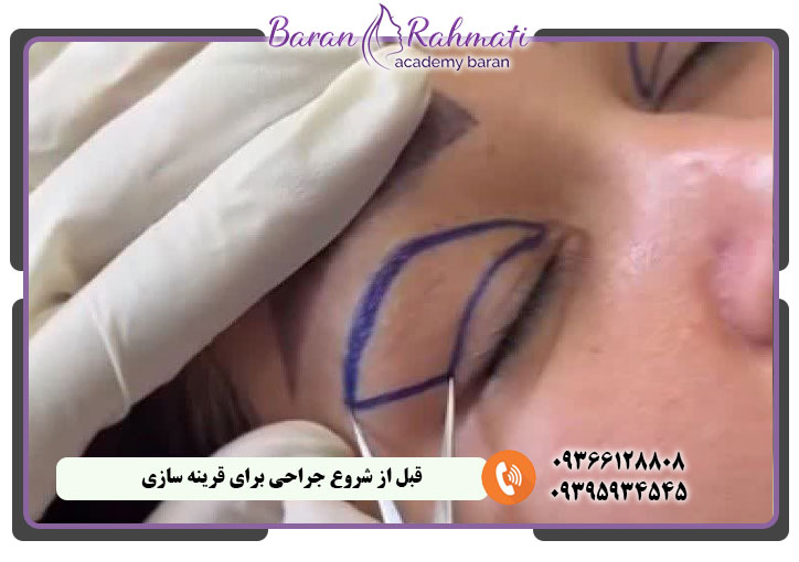 قبل از شروع جراحی برای قرینه سازی