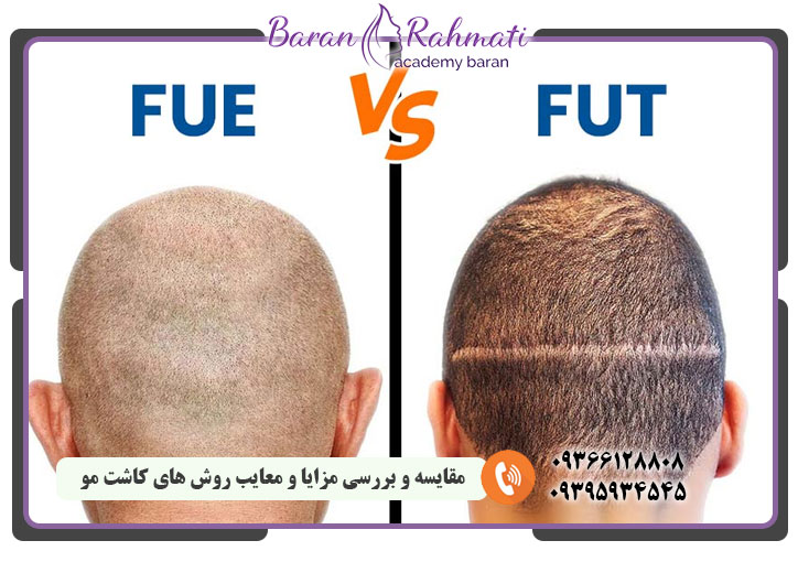مقایسه روش های کاشت مو