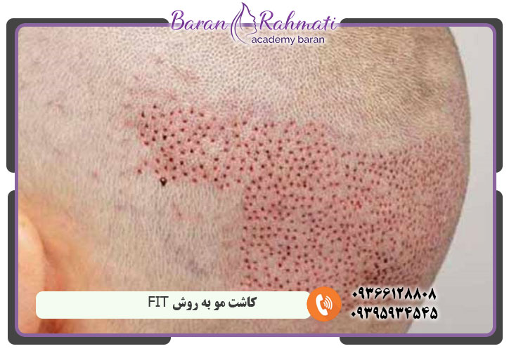 کاشت مو به روش FIT