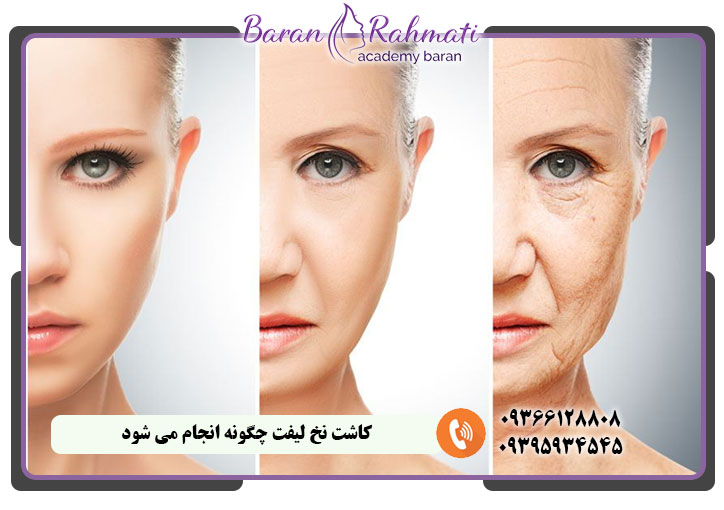 کاشت نخ لیفت چگونه انجام می شود