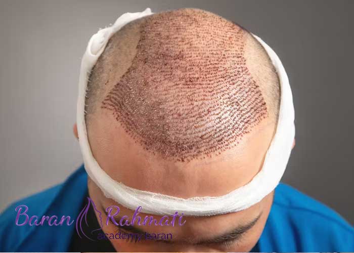 Read more about the article آموزش کاشت مو در اراک