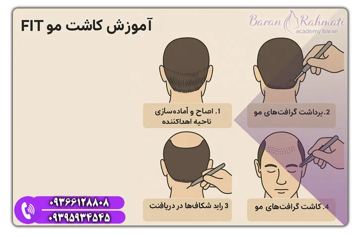 آموزش کاشت مو روش FIT