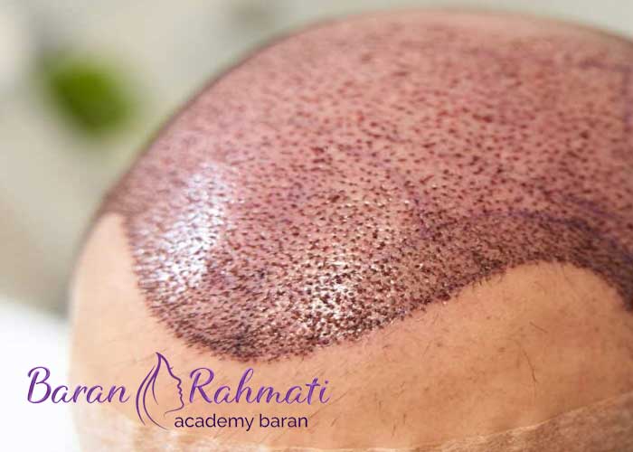 Read more about the article آموزش کاشت مو در کیش