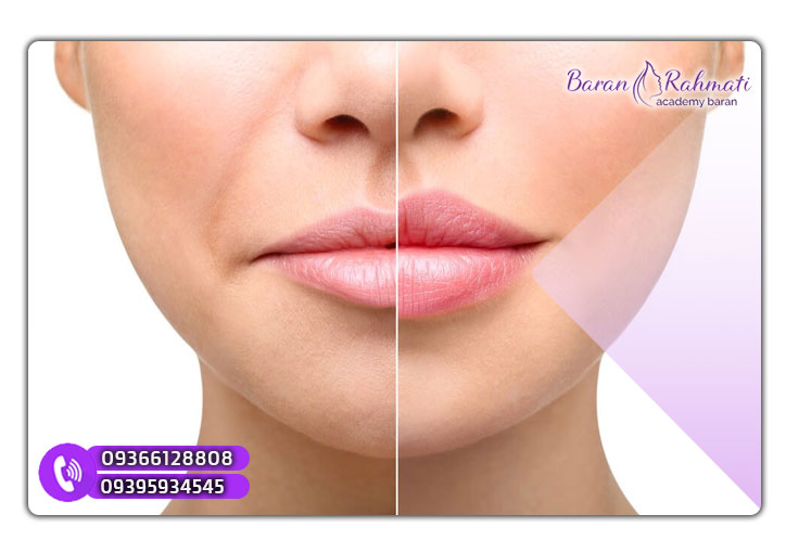 روش های کاهش درد تزریق ژل لب