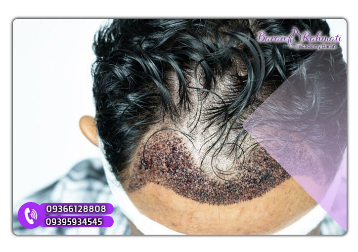  دوره یادگیری کاشت مو در اراک