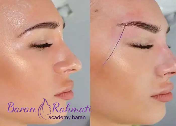 Read more about the article آموزش لیفت شقیقه در کردستان