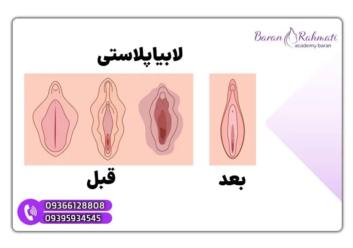دوره کوتاه‌مدت لابیاپلاستی در رشت برای پزشکان عمومی به صورت قبل و بعد