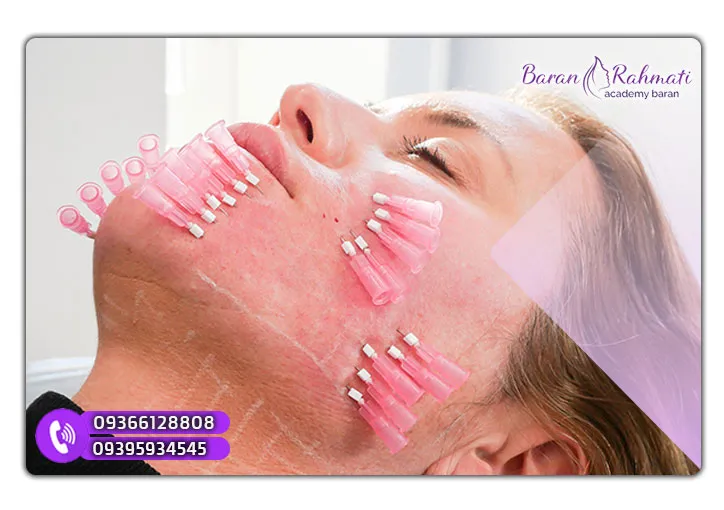 آموزش تخصصی کاشت نخ لیفت صورت در اراک
