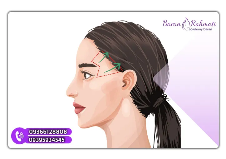آموزش لیفت شقیقه در کرمانشاه