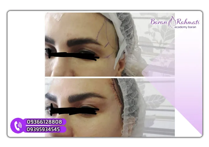 جراحی دائم لیفت شقیقه و چشم گربه ای و ابرو