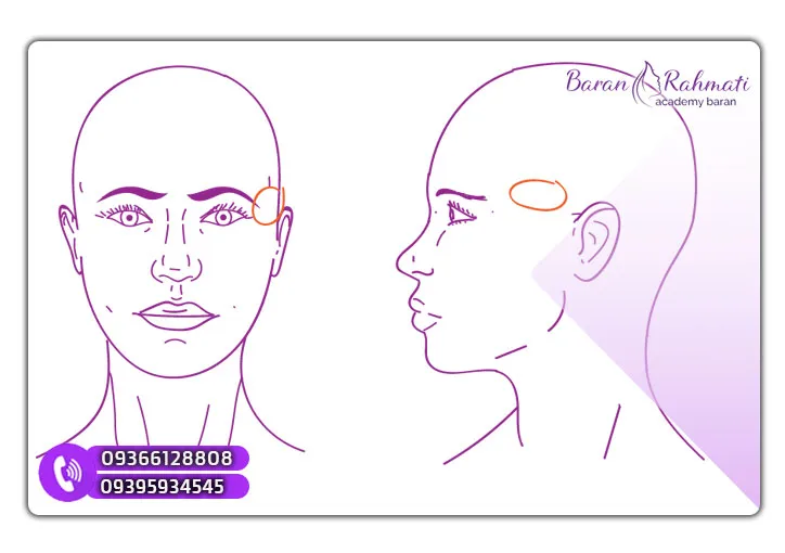 لیفت شقیقه در کرج