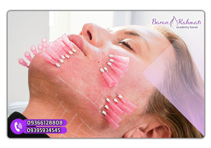 کاشت نخ لیفت بهترین روش جوانسازی پوست صورت