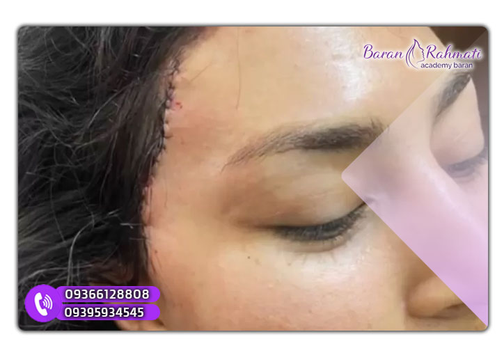 محل جراحی لیفت شقسقه
