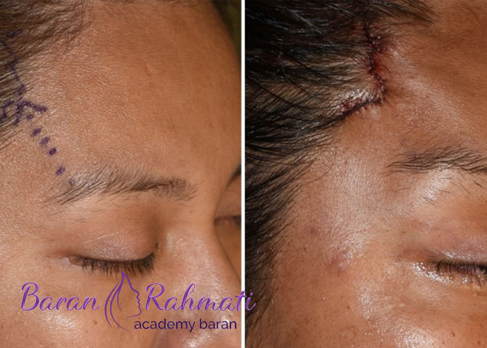 Read more about the article آموزش لیفت شقیقه در شیراز