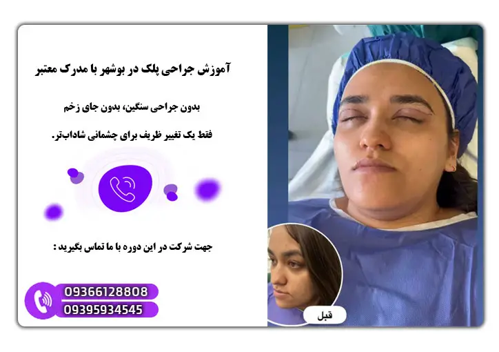 آموزش گام به گام بلفاروپلاستی پلک 