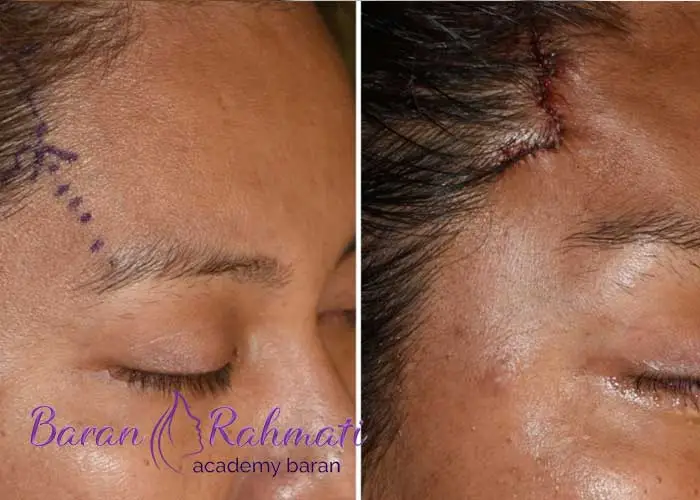 Read more about the article آموزش لیفت شقیقه در یزد