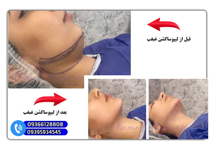 قبل و بعد لیپوساکشن غبغب