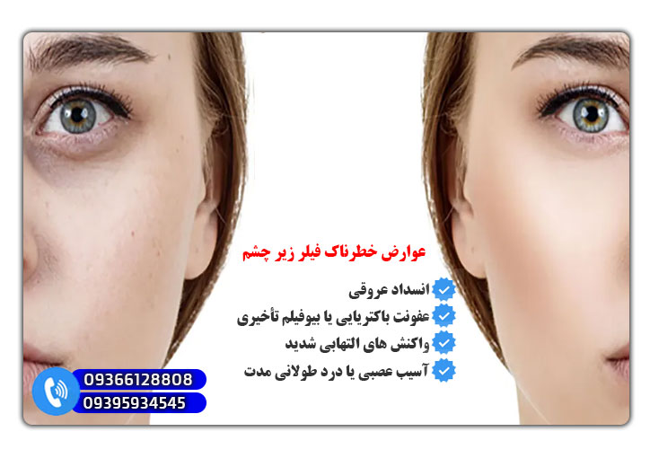 عوارض خطرناک فیلر زیر چشم
