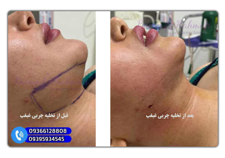 آموزش لیپوماتیک غبغب در بوشهر