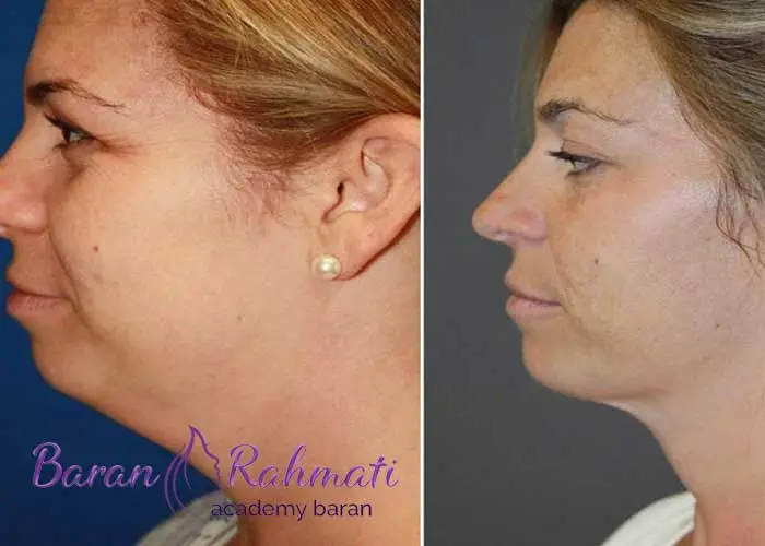 Read more about the article آموزش لیپوساکشن غبغب در بوشهر