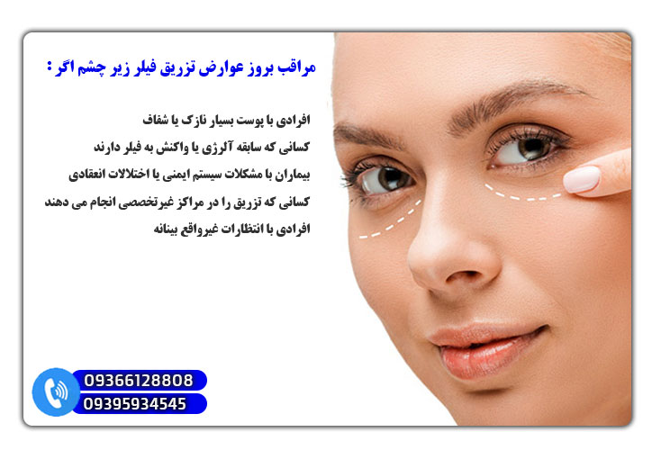 افراد مستعد برای عوارض فیلر زیر چشم