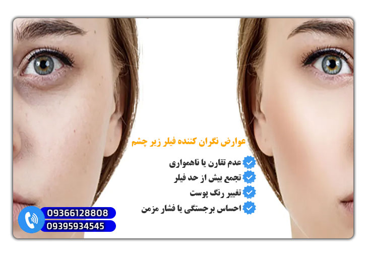 عوارض نگران کننده فیلر زیر چشم