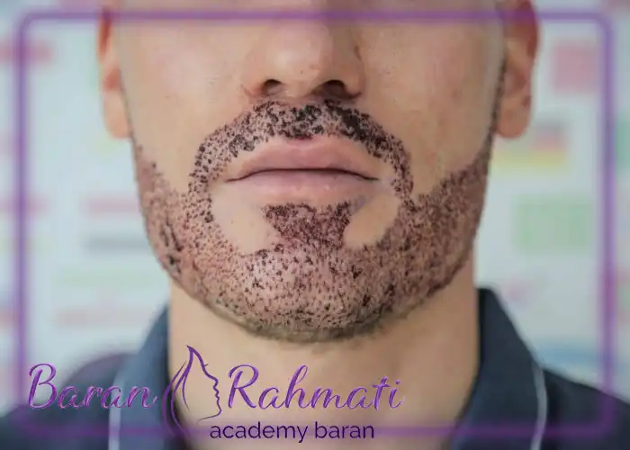 آموزش کاشت ریش