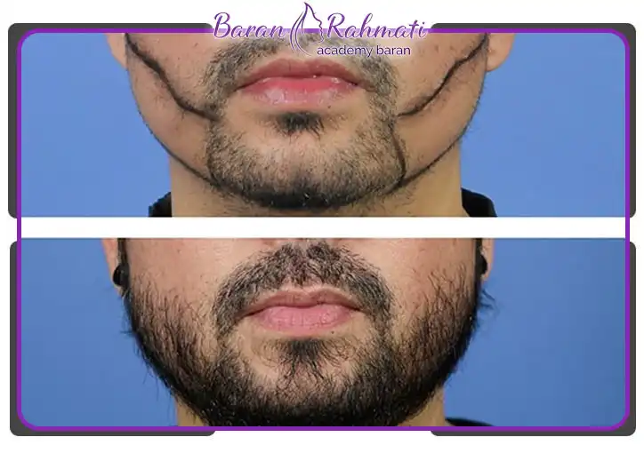 دوره های کاشت ریش