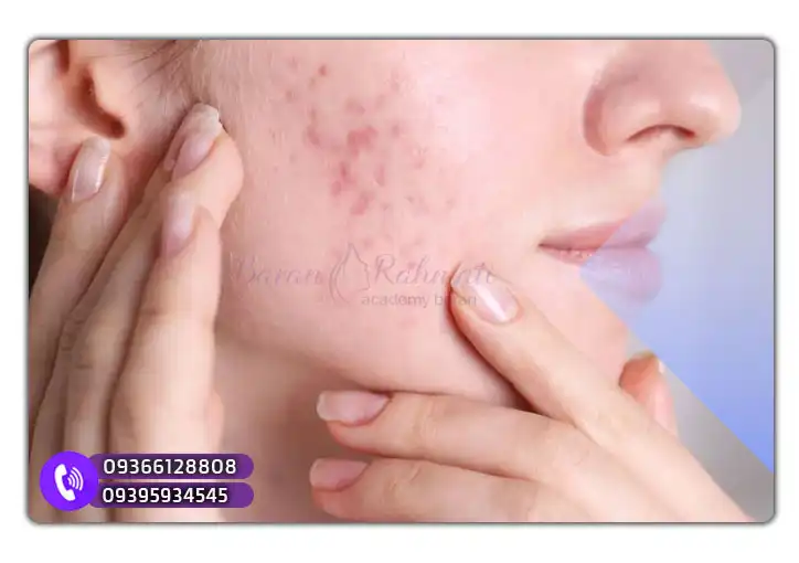 اگزوزوم برای جای جوش