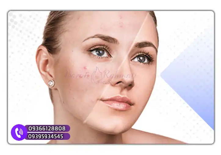 مزایای درمان مزوتراپی