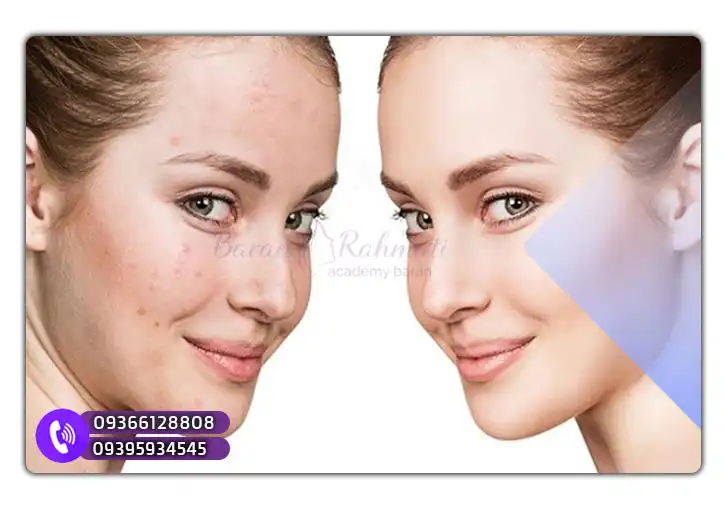 هزینه آموزش مزوتراپی در شیراز