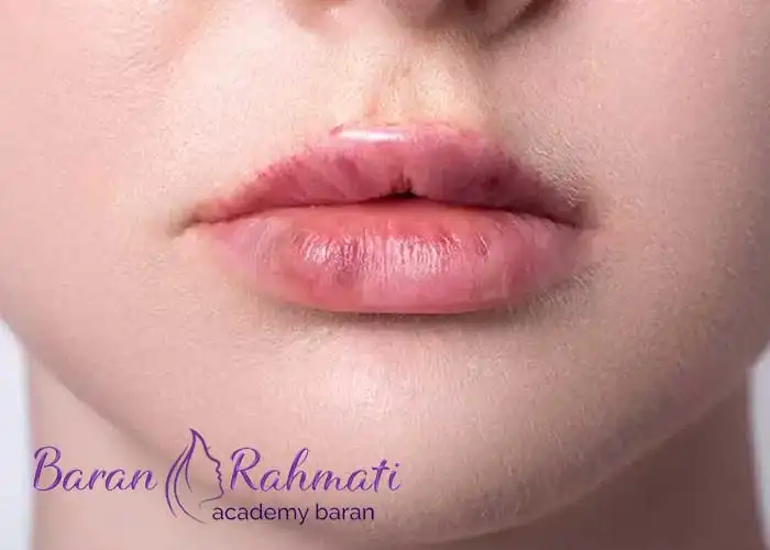 Read more about the article علائم حساسیت به ژل لب