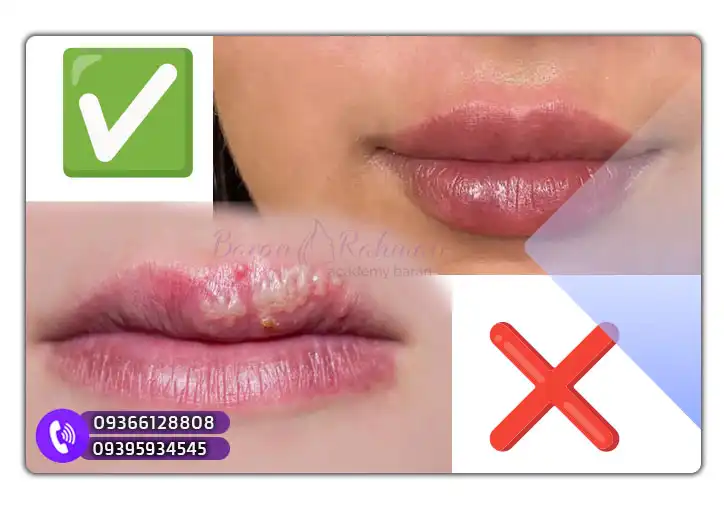 تفاوت بین عوارض طبیعی و حساسیت واقعی  ژل لب