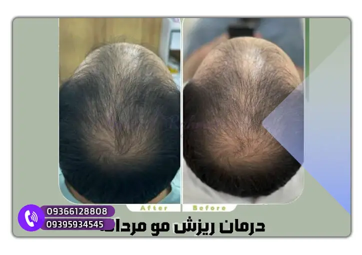 اگزوزوم تراپی برای ریزش مو