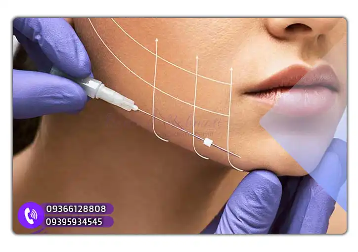 فرآیند انجام لیفت با نخ کاگ