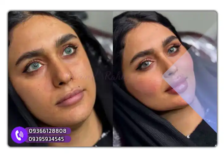 هزینه شرکت در آموزش مزوژل در مشهد