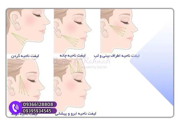 سرفصل های لیفت با نخ در مشهد